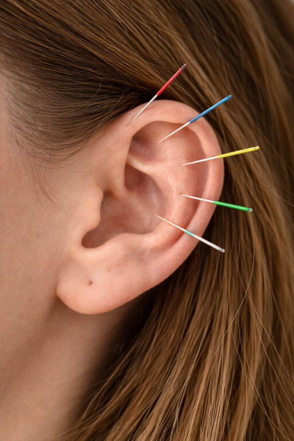 Gesundheitszentrum Werth - Physiotherapie und medizinische Behandlungen - Nahaufnahme mehrerer mehrfarbiger Akupunkturnadeln, die in das Ohr einer Person eingeführt wurden.